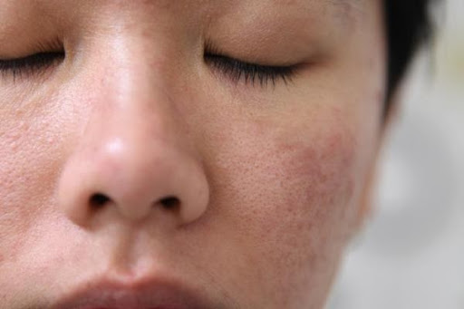 Cara Menangani Kulit dengan Ciri-ciri Skin Barrier Rusak